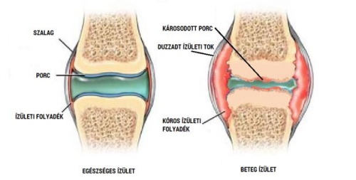 hogyan kezelhető a rheumatoid arthritis modern eszközökkel égő fájdalom a boka ízületében