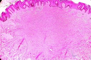 A histiocytoma a kutyáknál