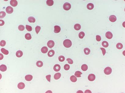 Kutya thrombocytopenia